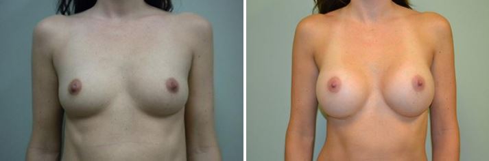 Breast-Augmentation-Naperville