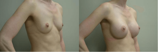Breast-Augmentation-Surgery-Napeville