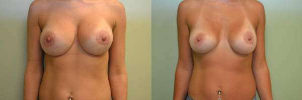 Breast-Implants-Naperville