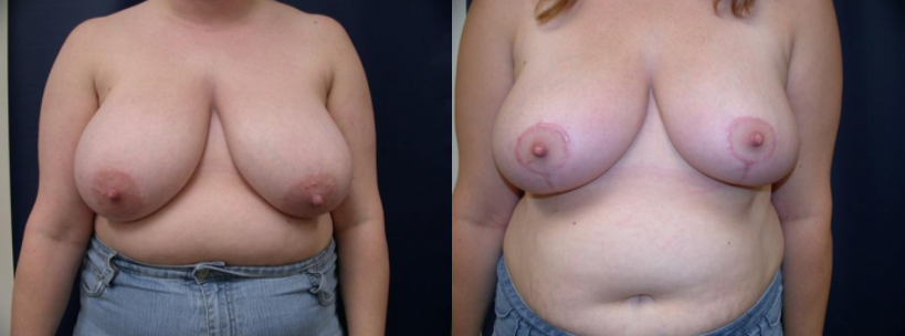 Breast-Reduction-Naperville