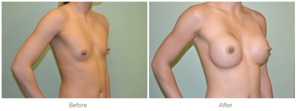 Cost-of-Breast-Augmentation-in-Naperville