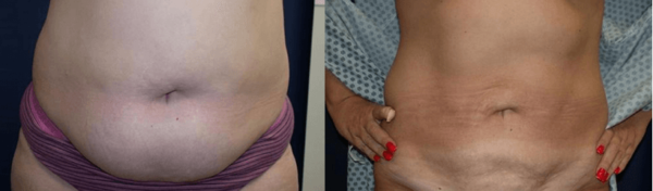 Naperville-Liposuction