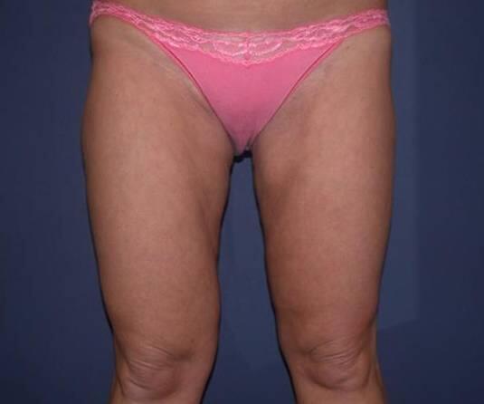 Thigh lift Before & After Image