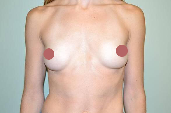 Breast Lift  Before & After Image
