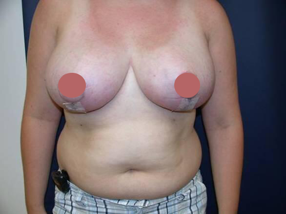 Breast Reduction  Before & After Image